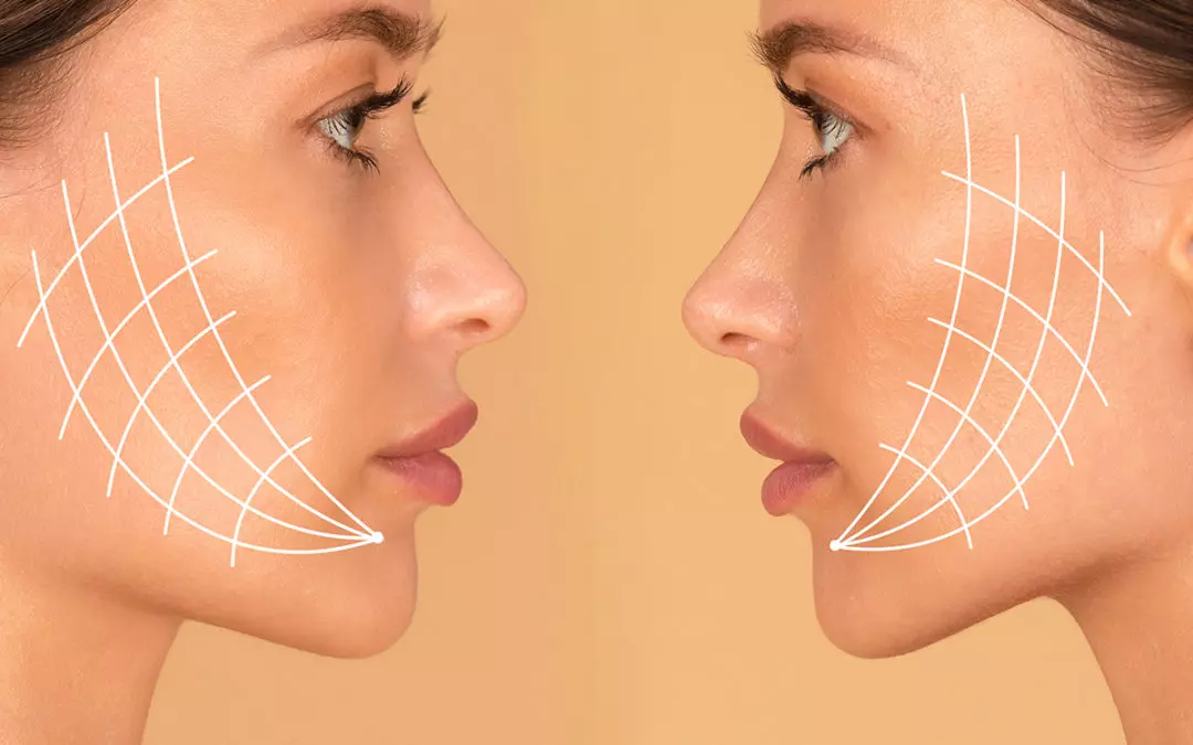 Hilos Reabsorbibles Pdo imagen 4